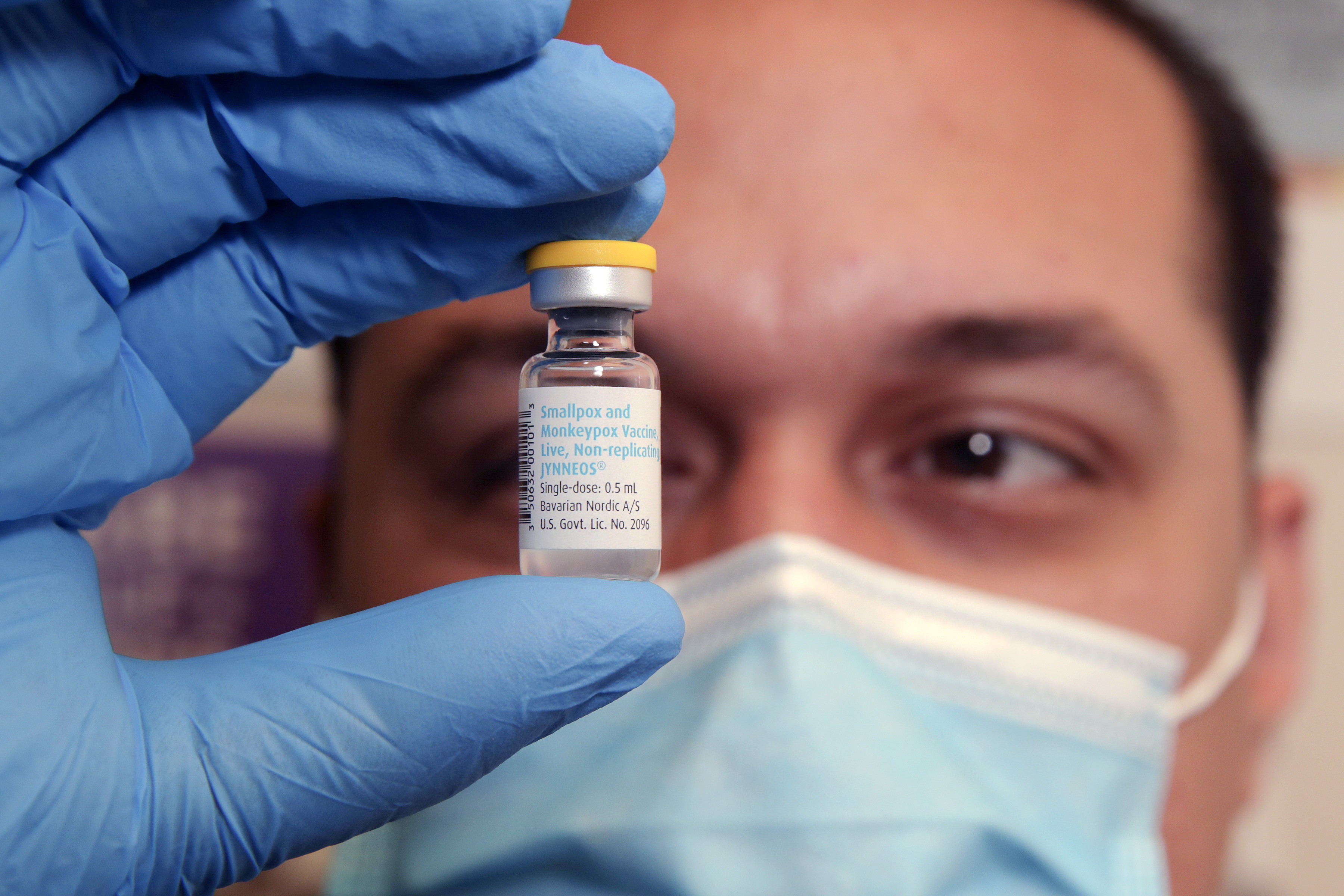Orange County reports first monkeypox infection in child - Vimarsana News