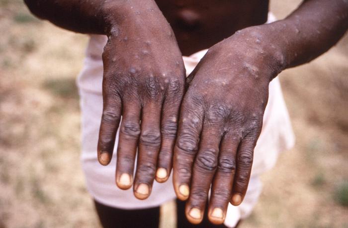 Sex, rashes and outbreaks: A rational guide to the moneypox risk in California - Vimarsana News