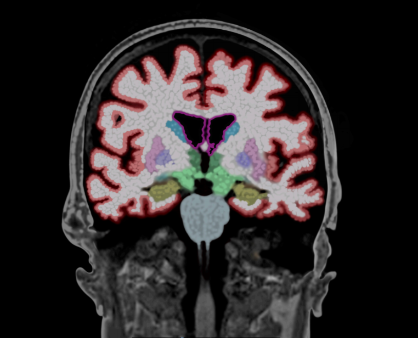 UC San Diego seeks patients to help test new treatment for Alzheimer's disease - Vimarsana News