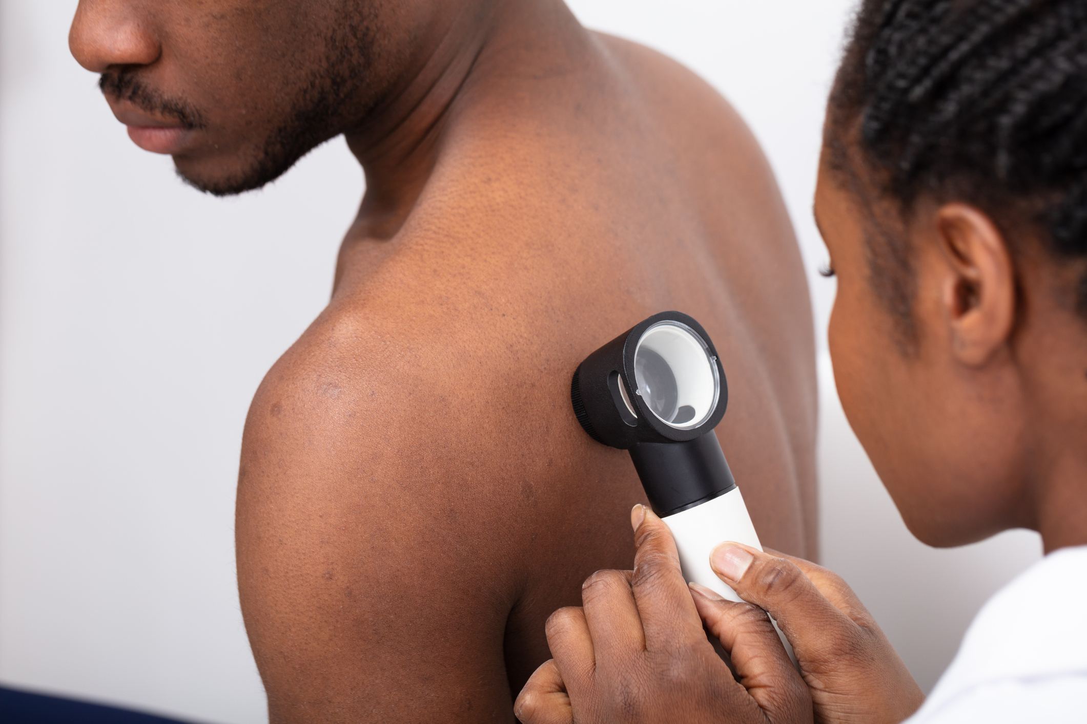 Skin cancer is a risk for anyone, but it's more likely to be missed in people with dark skin - Vimarsana News