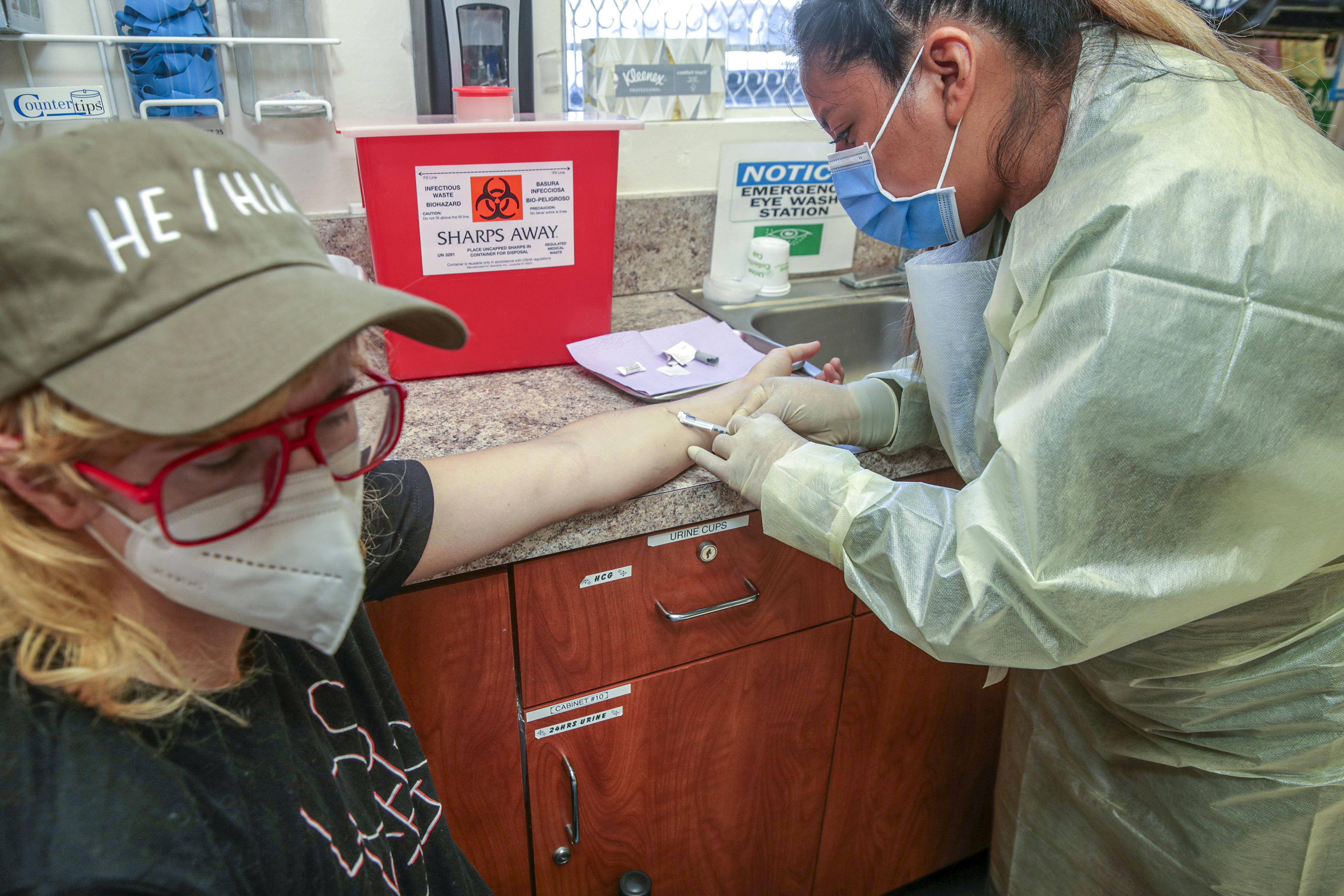 MPX cases falling dramatically in California. Is the outbreak ending? - Vimarsana News