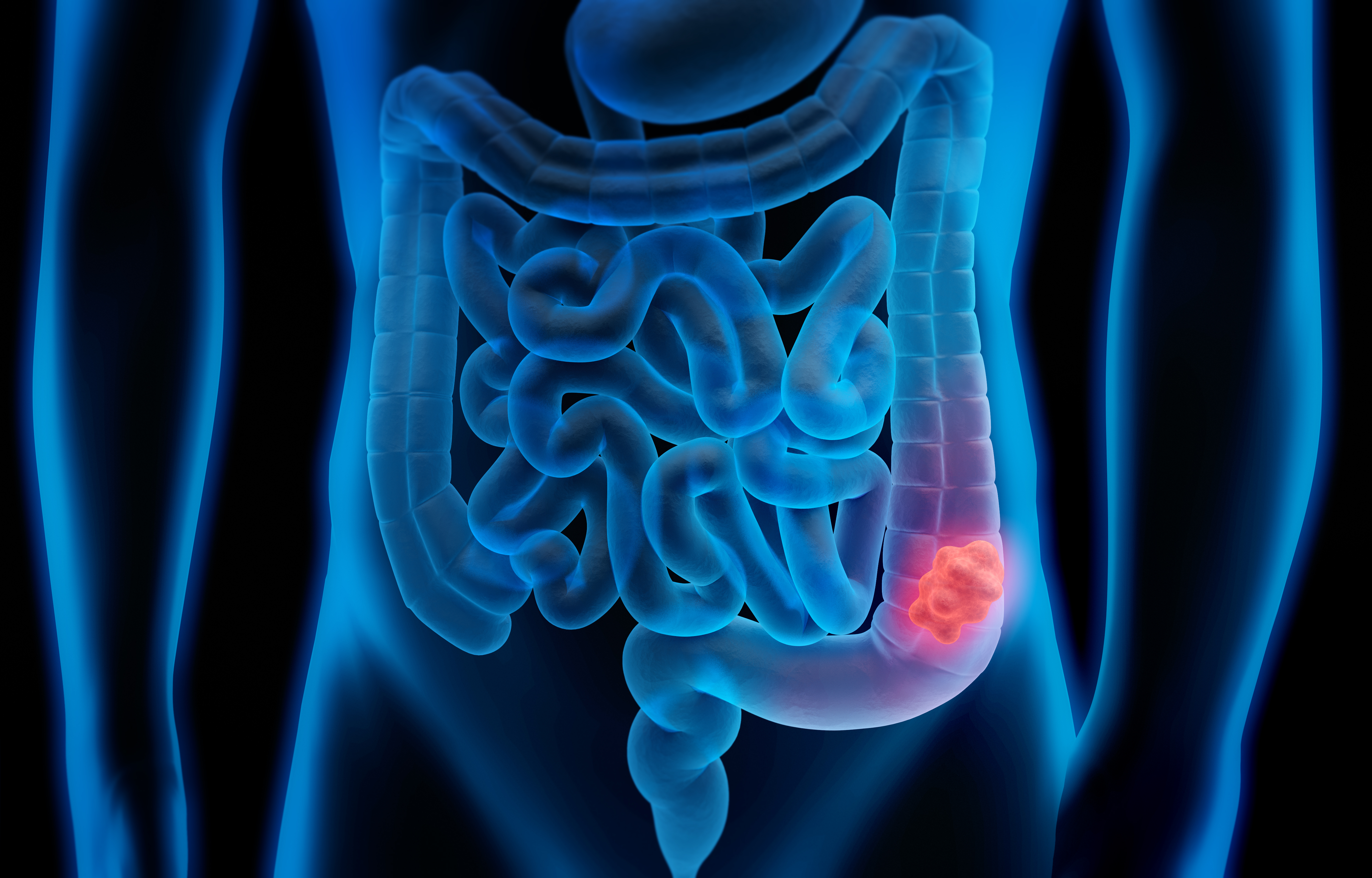 Treat colon cancer screening as if your life depends on it. It just might. - Vimarsana News
