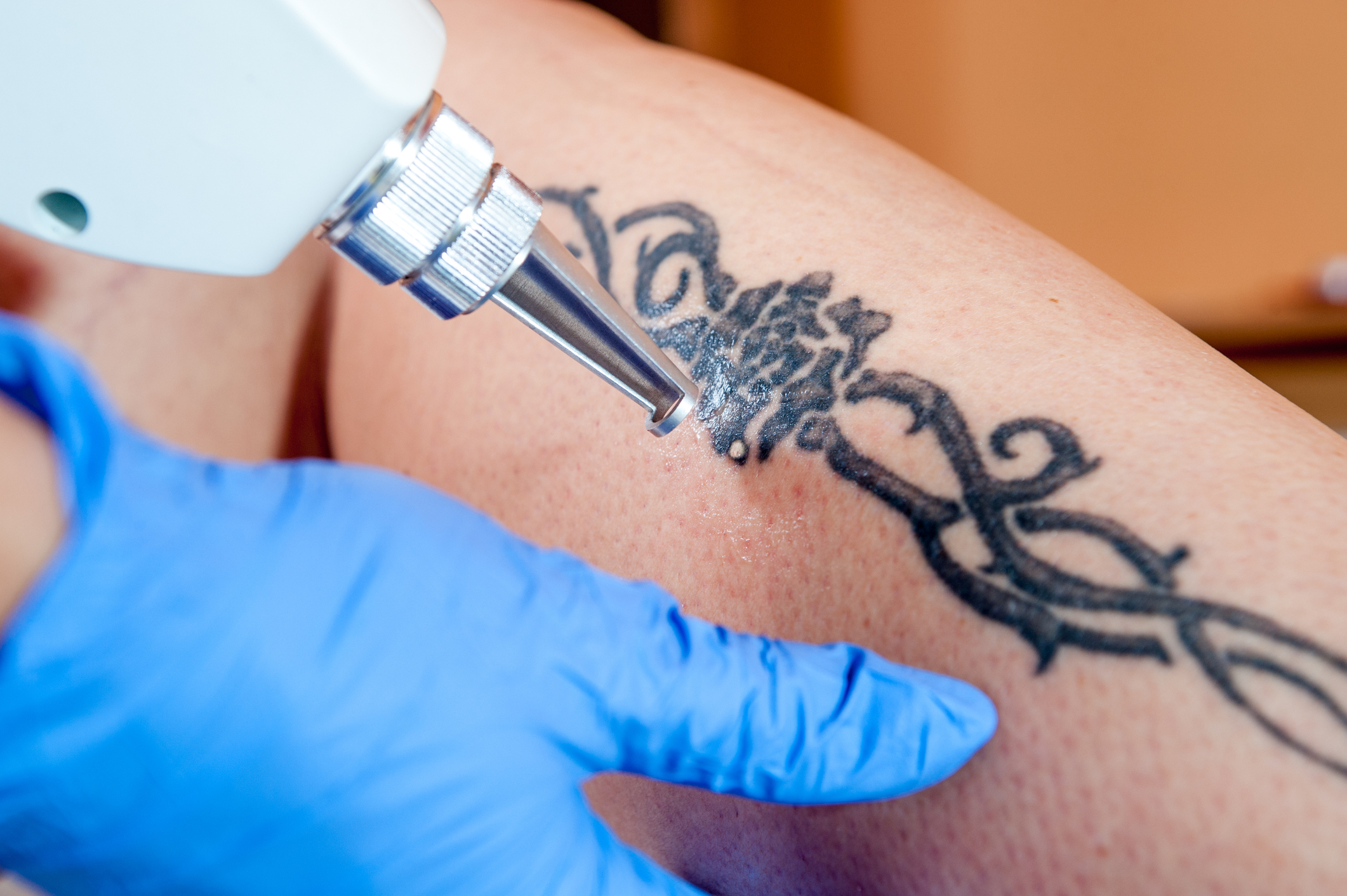 Opinion: Here's how tattoo removal is allowing some former inmates to become productive in society. - Vimarsana News