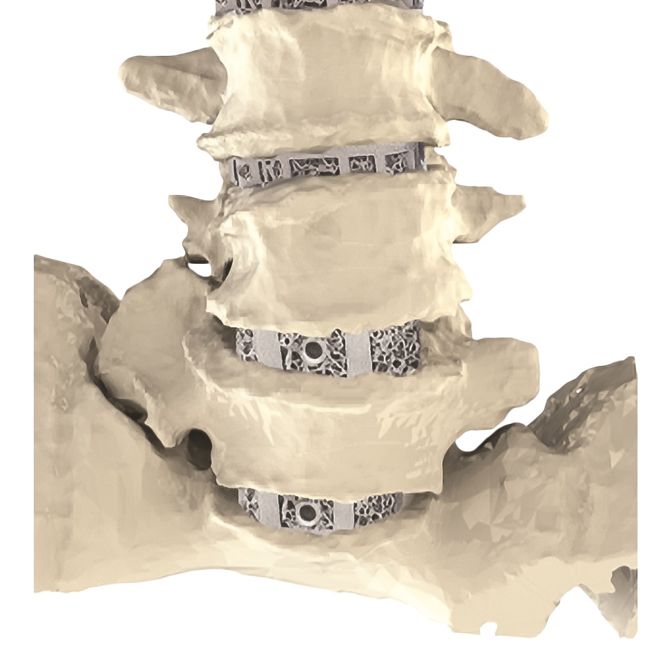 San Diego's Carlsmed corrals $10 million to bring personalized medicine to spine surgeries - Vimarsana News